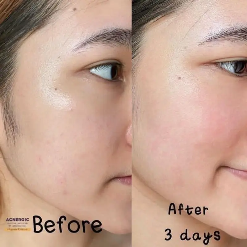 Before & After การเปลี่ยนแปลงผิวชัดเจนจากผลิตภัณฑ์ลดสิว