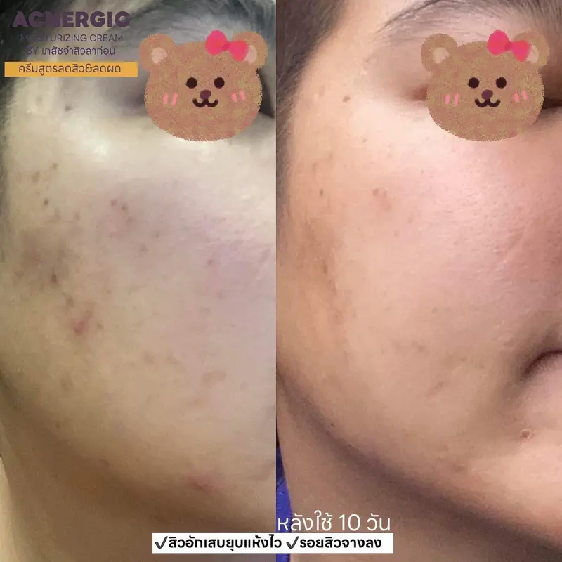 Before & After เปรียบเทียบผิวก่อนและหลังใช้ครีมลดสิว