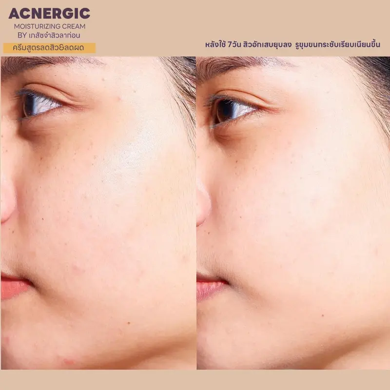 รีวิว Before & After การเปลี่ยนแปลงผิวใสจากผลิตภัณฑ์