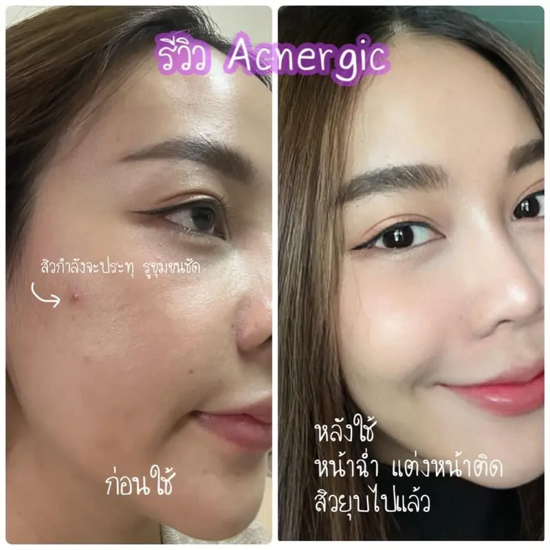Before & After การฟื้นฟูผิวแพ้ง่ายจากผลิตภัณฑ์ออร์แกนิก