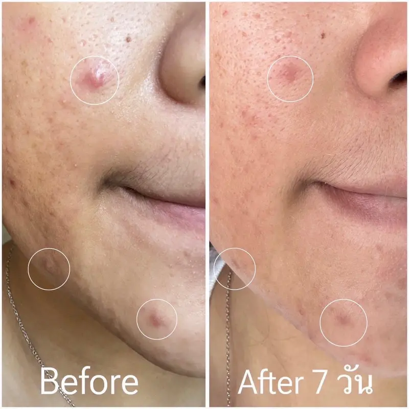 รีวิว Before & After ความเปลี่ยนแปลงผิวหลังใช้ครีมลดสิว