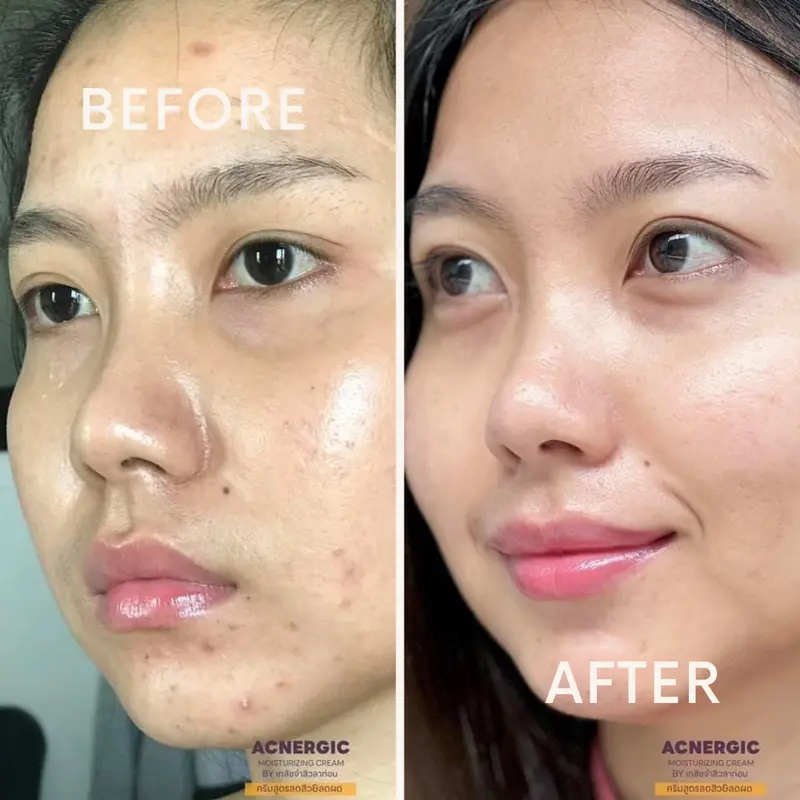 Before & After การลดสิวและฟื้นฟูผิวเสียให้กลับมาแข็งแรง